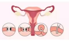 输卵管粘连会导致月经变少吗？有什么异常的体现